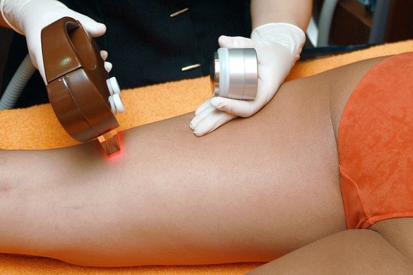 Épilation laser à lyon : la solution pour une peau douce